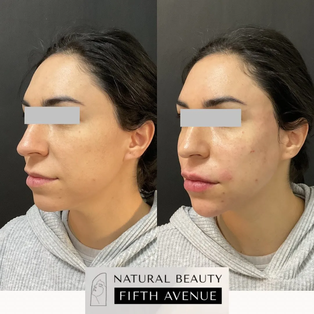 Dermal Fillers Case 2 before and after at Natural Beauty NYC (3 of 4)