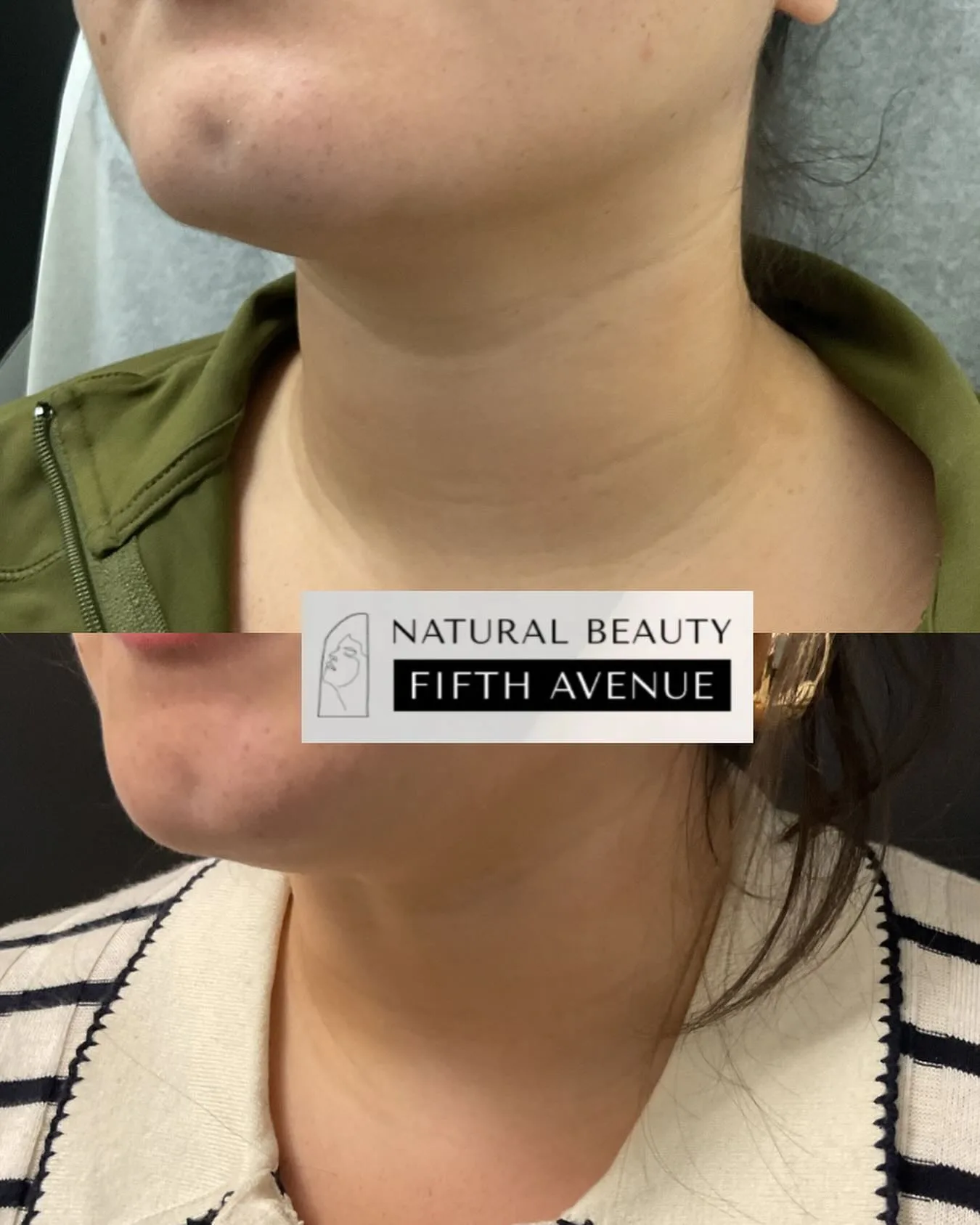 Filler and RF Microneedling before and after at Natural Beauty NYC (2 of 3)