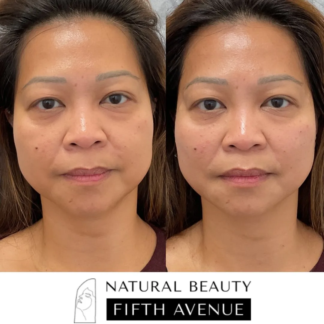 Radiesse Case 2 before and after at Natural Beauty NYC