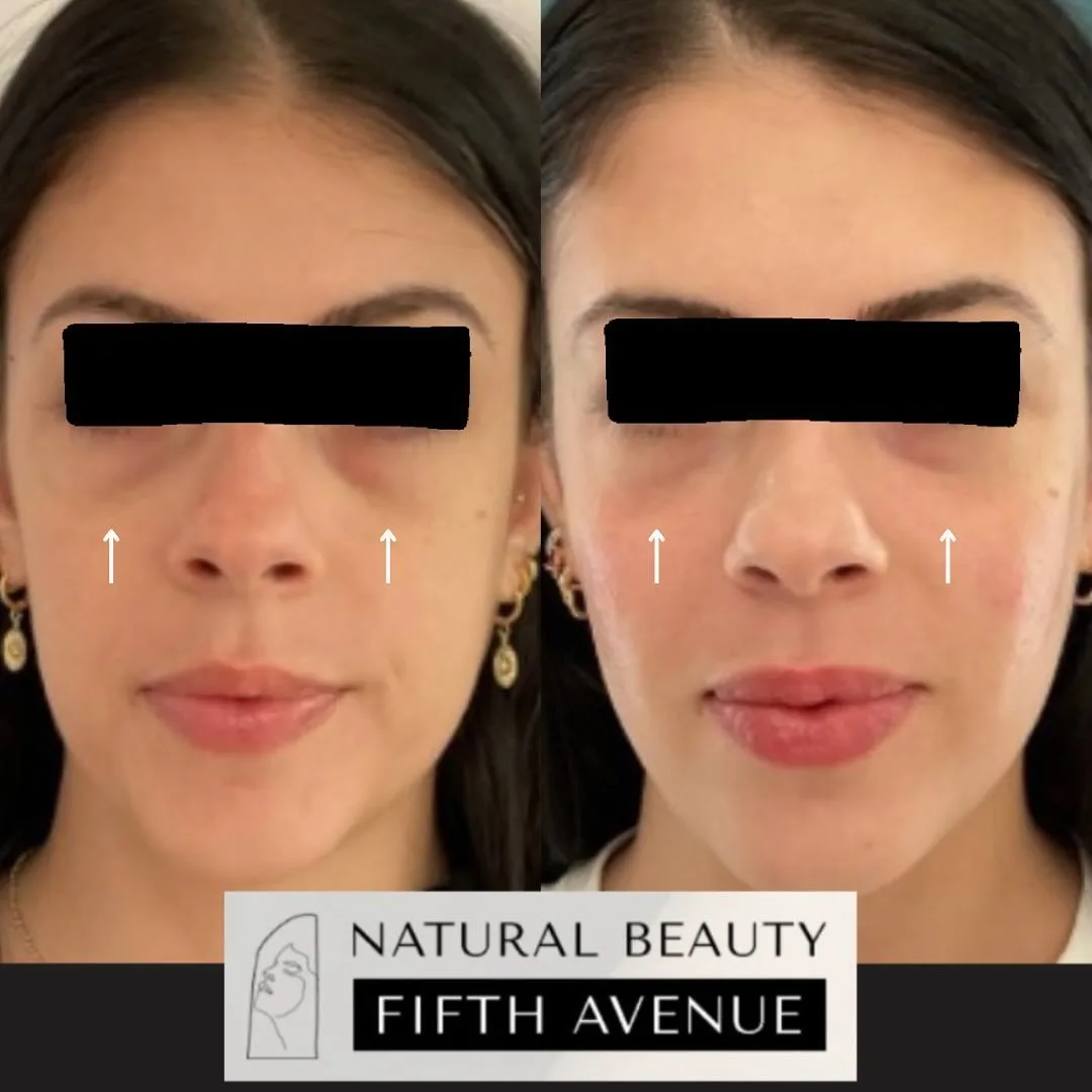 Dermal Filler Case 5 before and after