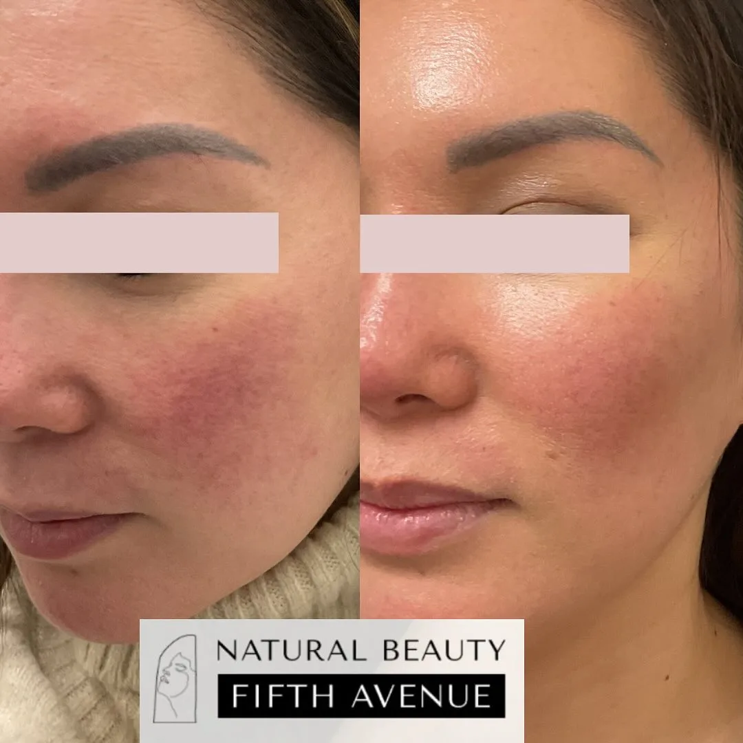 IPL Case 2 before and after at Natural Beauty NYC (3 of 3)