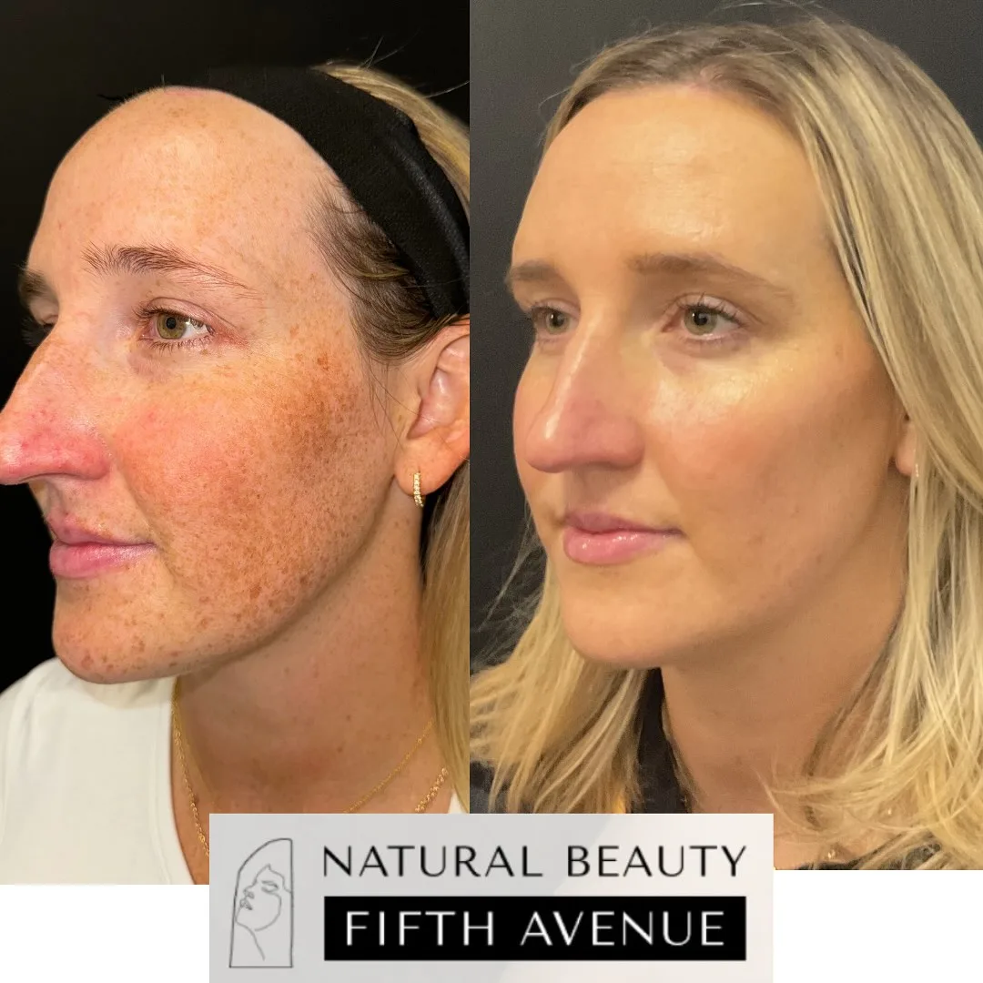 Skin Care after the procedure before and after