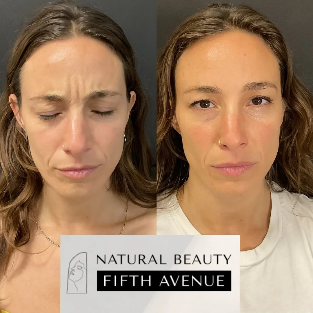 Daxxify before and after