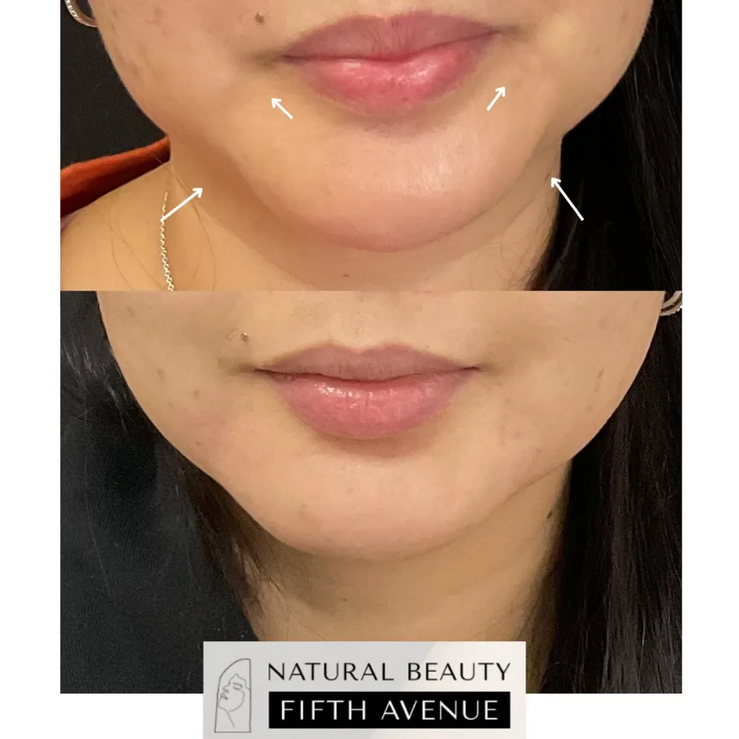 Hyaluronic Acid Fillers before and after at Natural Beauty NYC (3 of 3)
