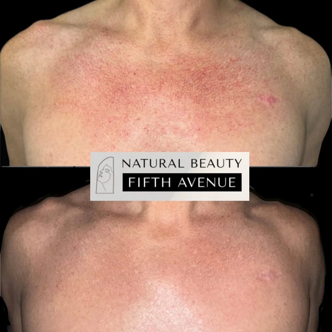 IPL treatment Case 5 before and after
