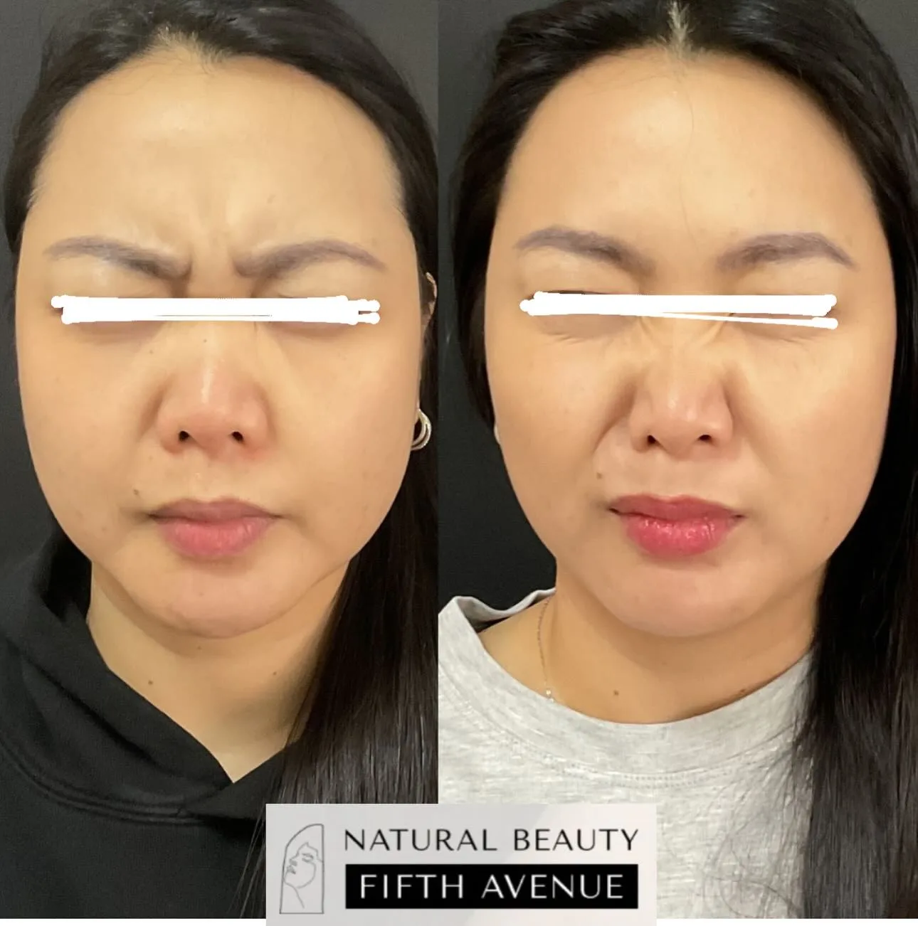 Wrinkle Relaxer & Filler before and after at Natural Beauty NYC (5 of 5)