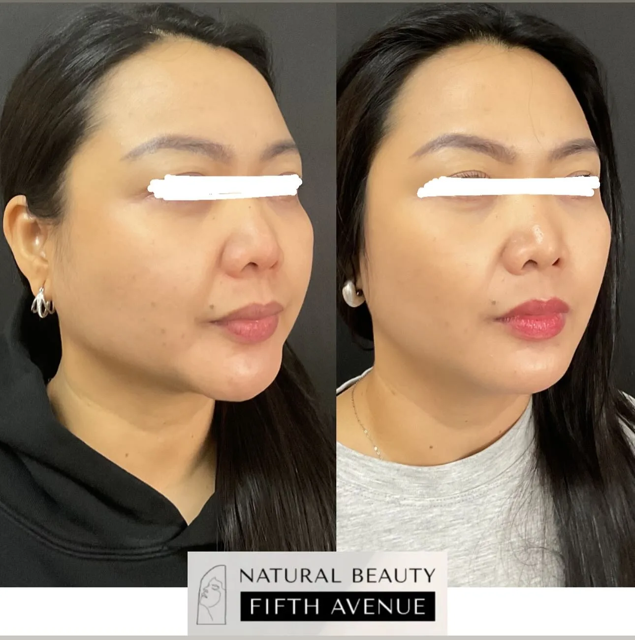 Wrinkle Relaxer & Filler before and after at Natural Beauty NYC (4 of 5)