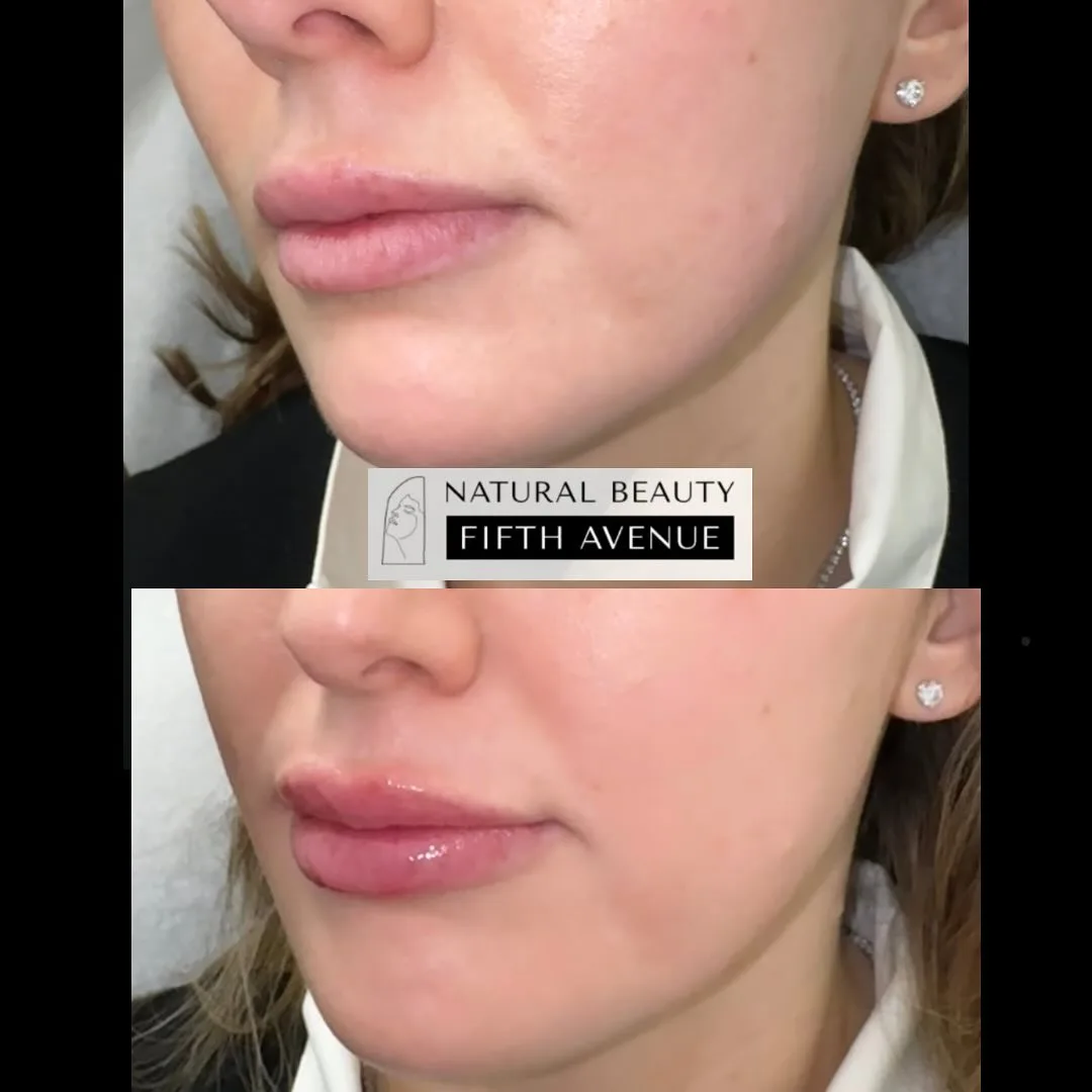Lip Gloss Method before and after at Natural Beauty NYC (2 of 3)