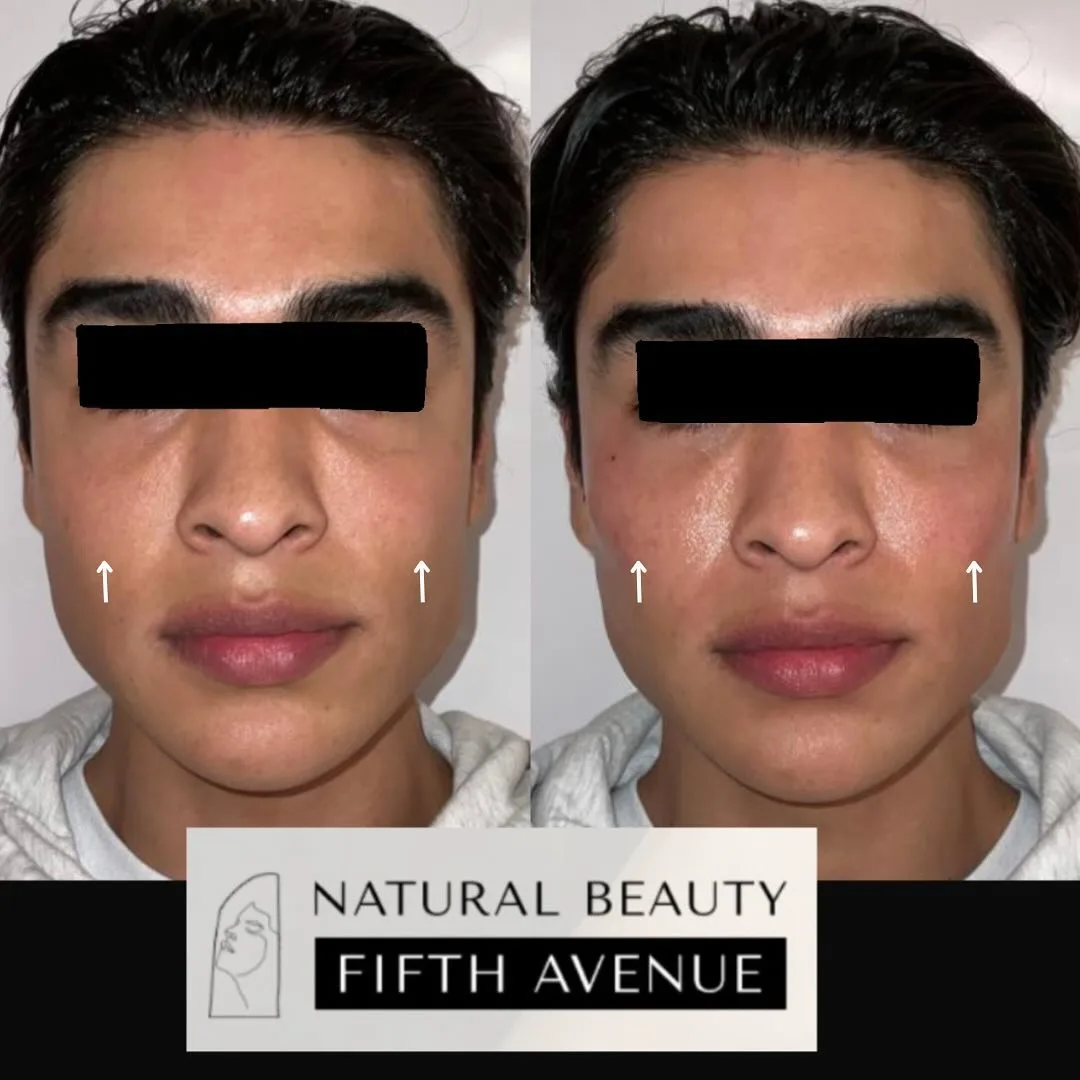 Dermal Filler Case 3 before and after