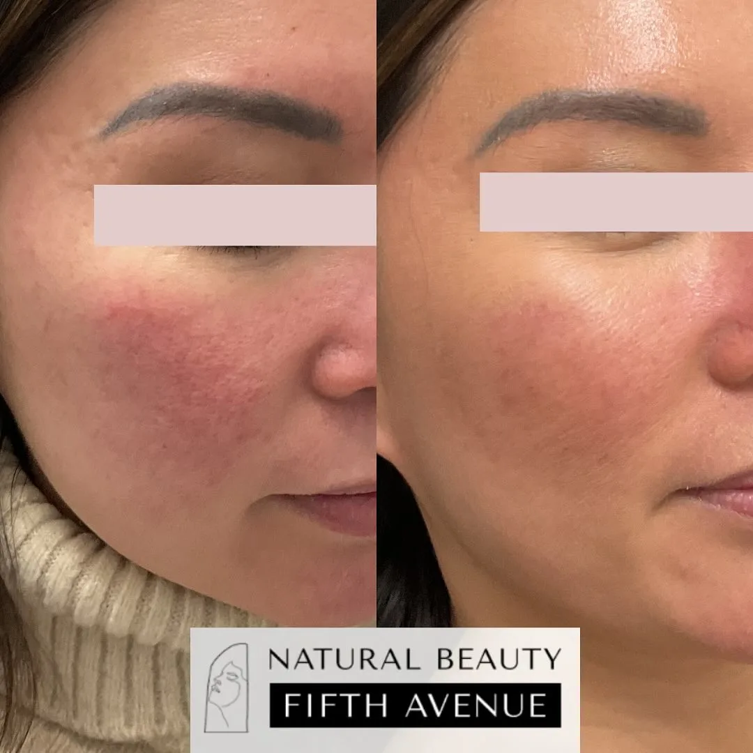 IPL Case 2 before and after at Natural Beauty NYC (2 of 3)