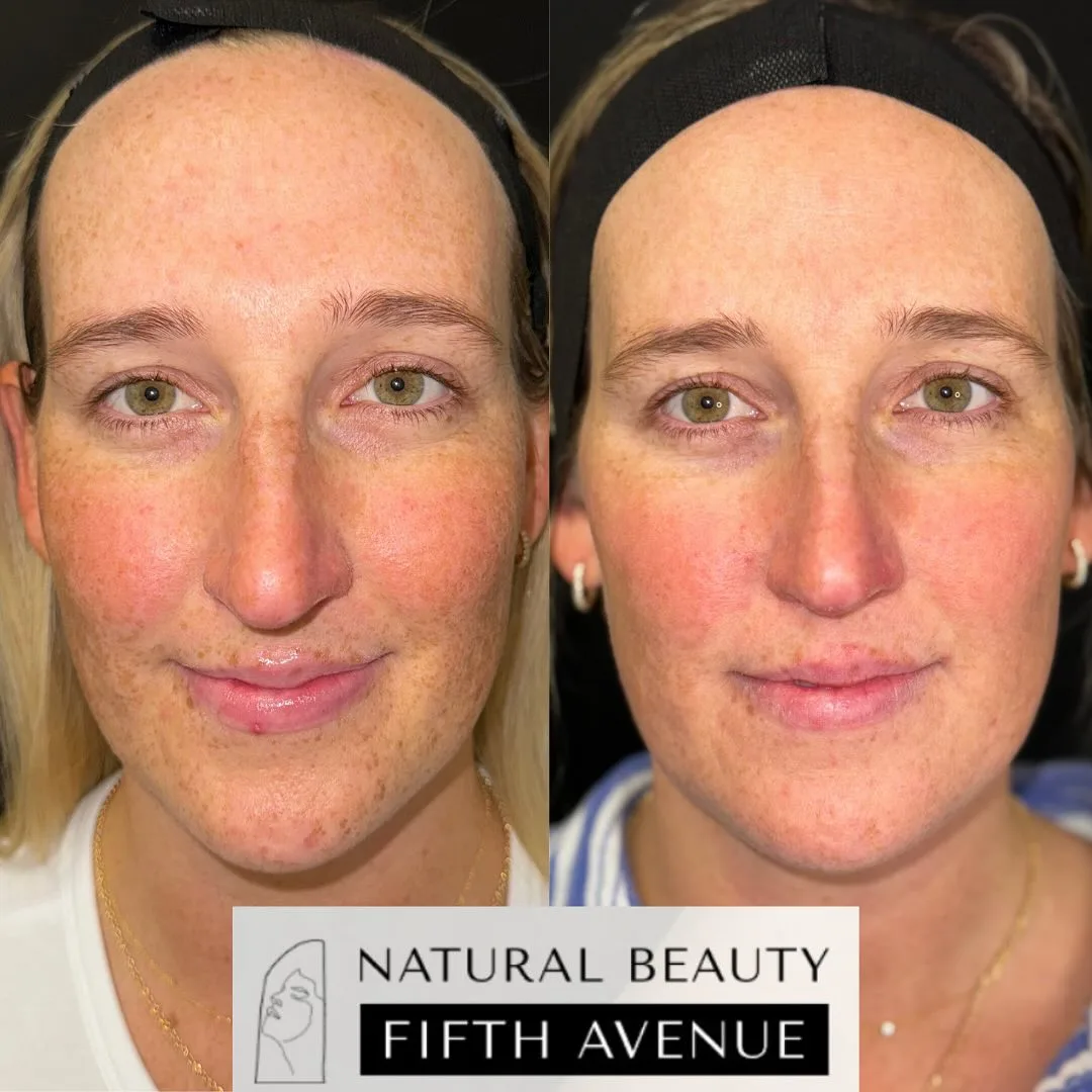IPL Case 1 before and after at Natural Beauty NYC (2 of 5)