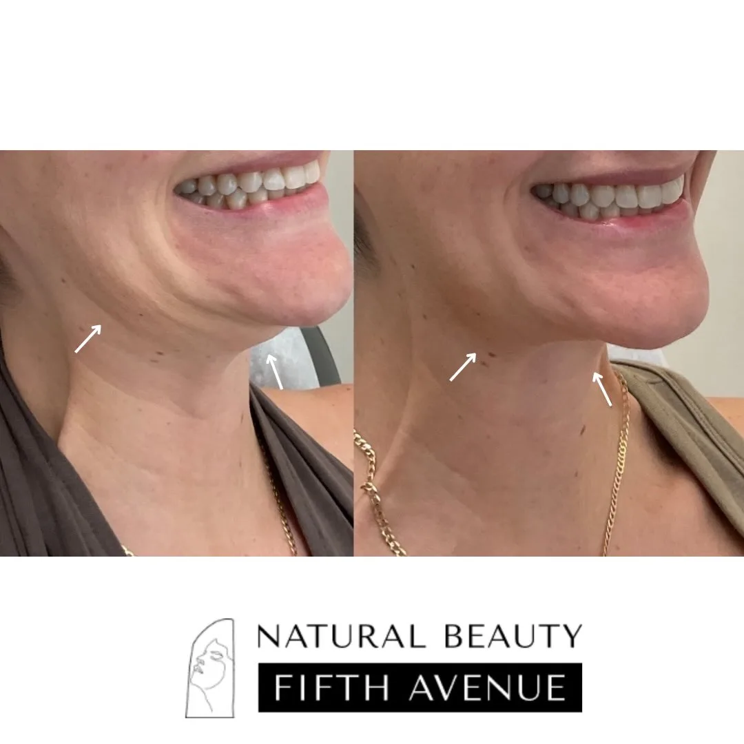 Nefertiti Lift Case 1 before and after at Natural Beauty NYC