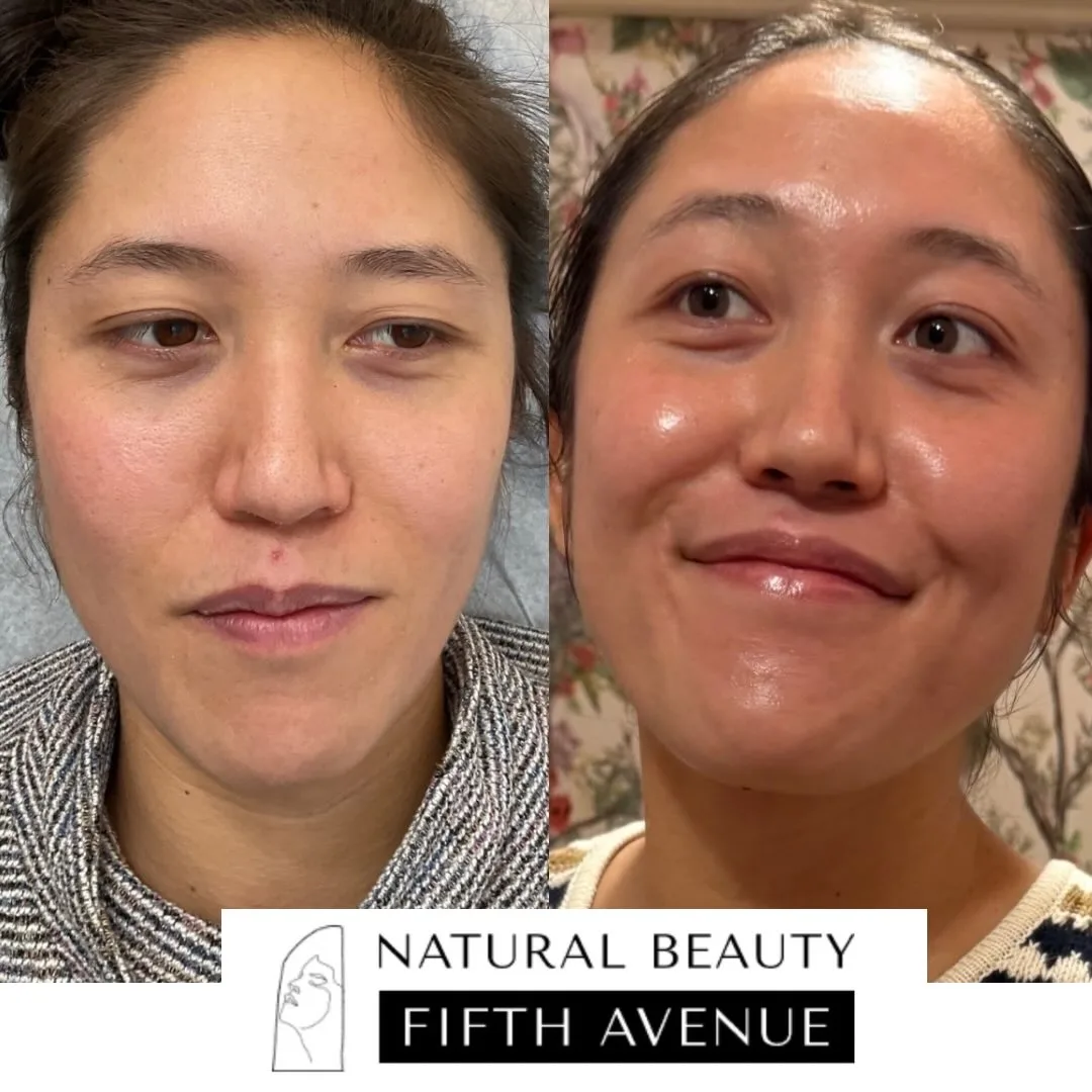 Chemical Peel Case 1 before and after