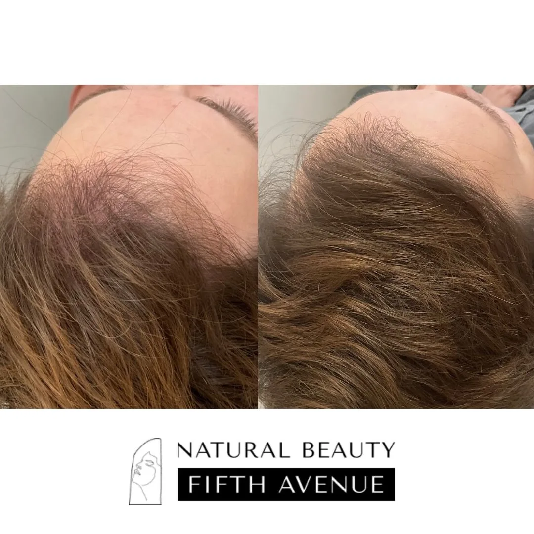 Hair Restoration Case 2 before and after
