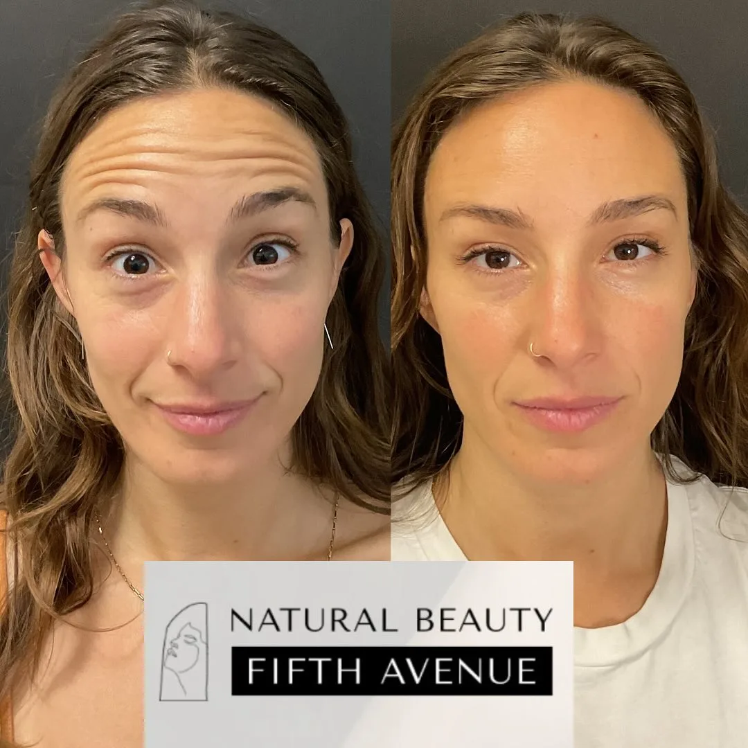 Daxxify before and after at Natural Beauty NYC (2 of 2)