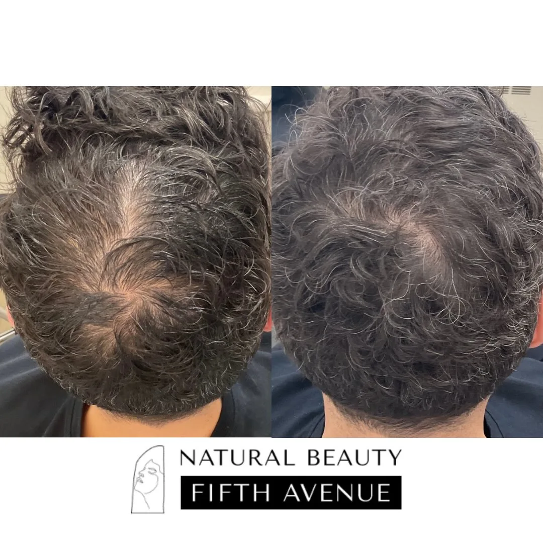 PRF Hair Restoration before and after