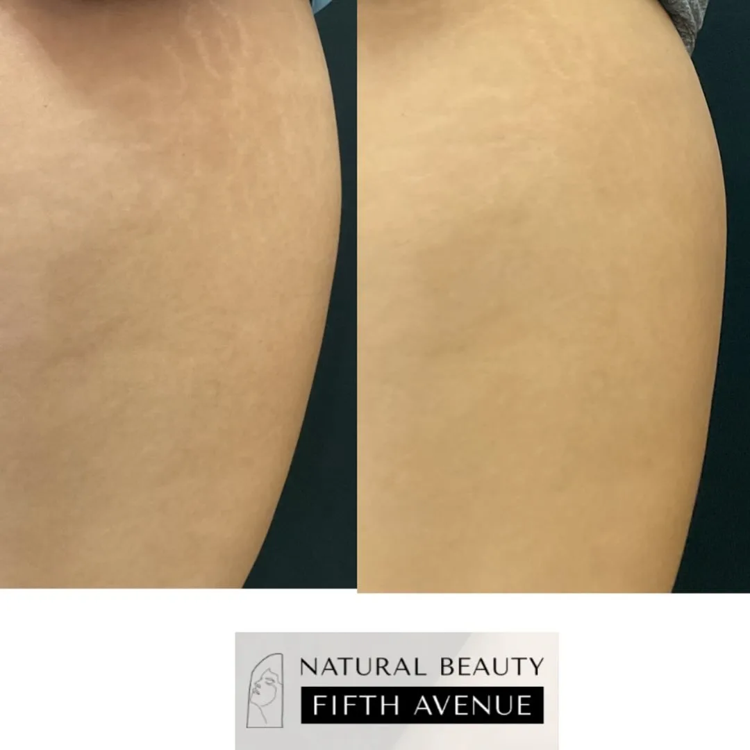 RF Microneedling with PRP Case 3 before and after