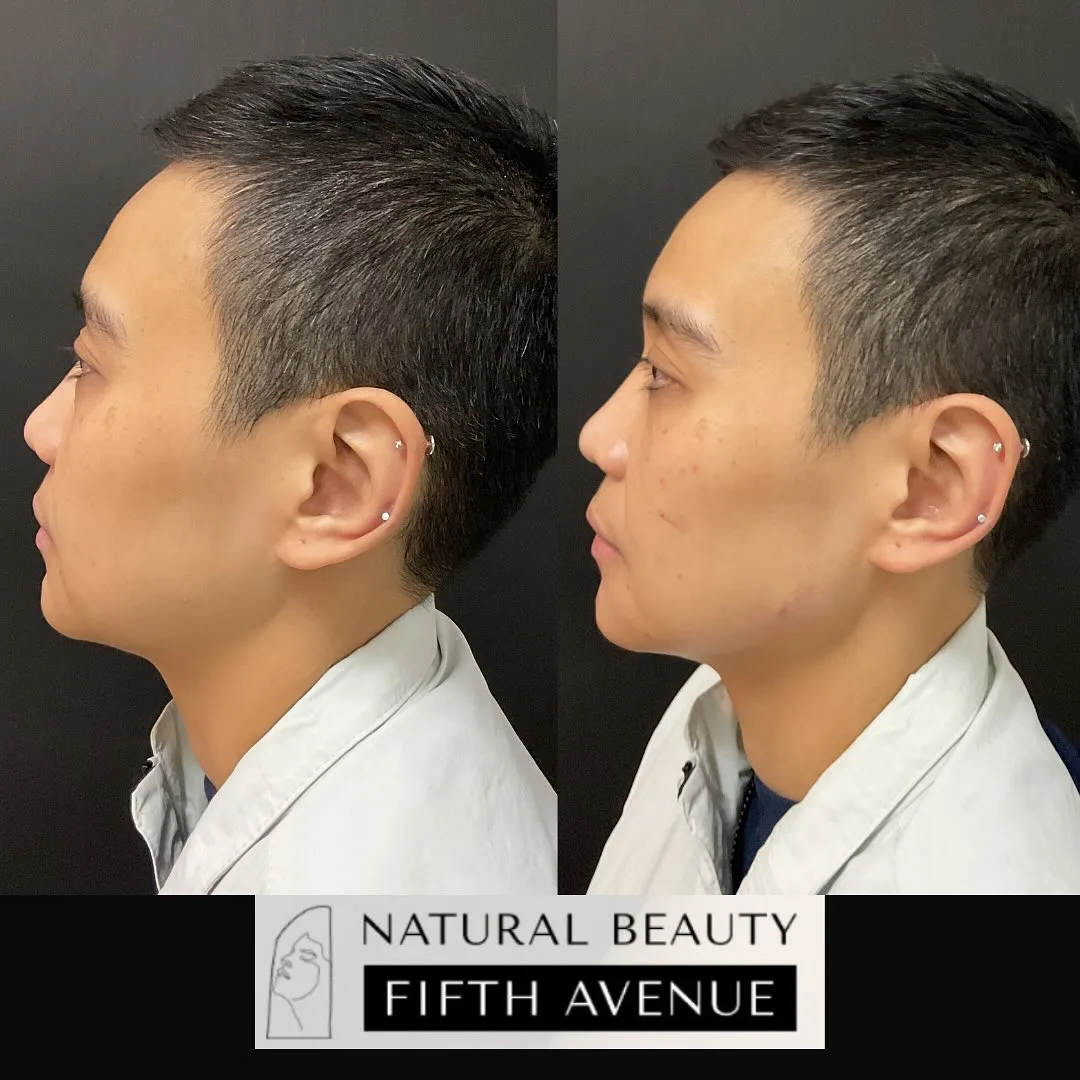 Dermal Filler Case 7 before and after at Natural Beauty NYC (2 of 4)