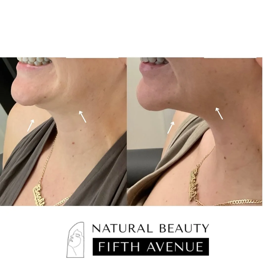 Nefertiti Lift Case 1 before and after at Natural Beauty NYC (3 of 3)