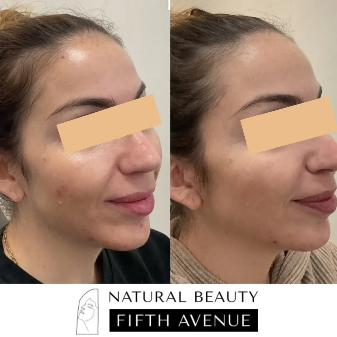 Radiesse Case 3 before and after at Natural Beauty NYC