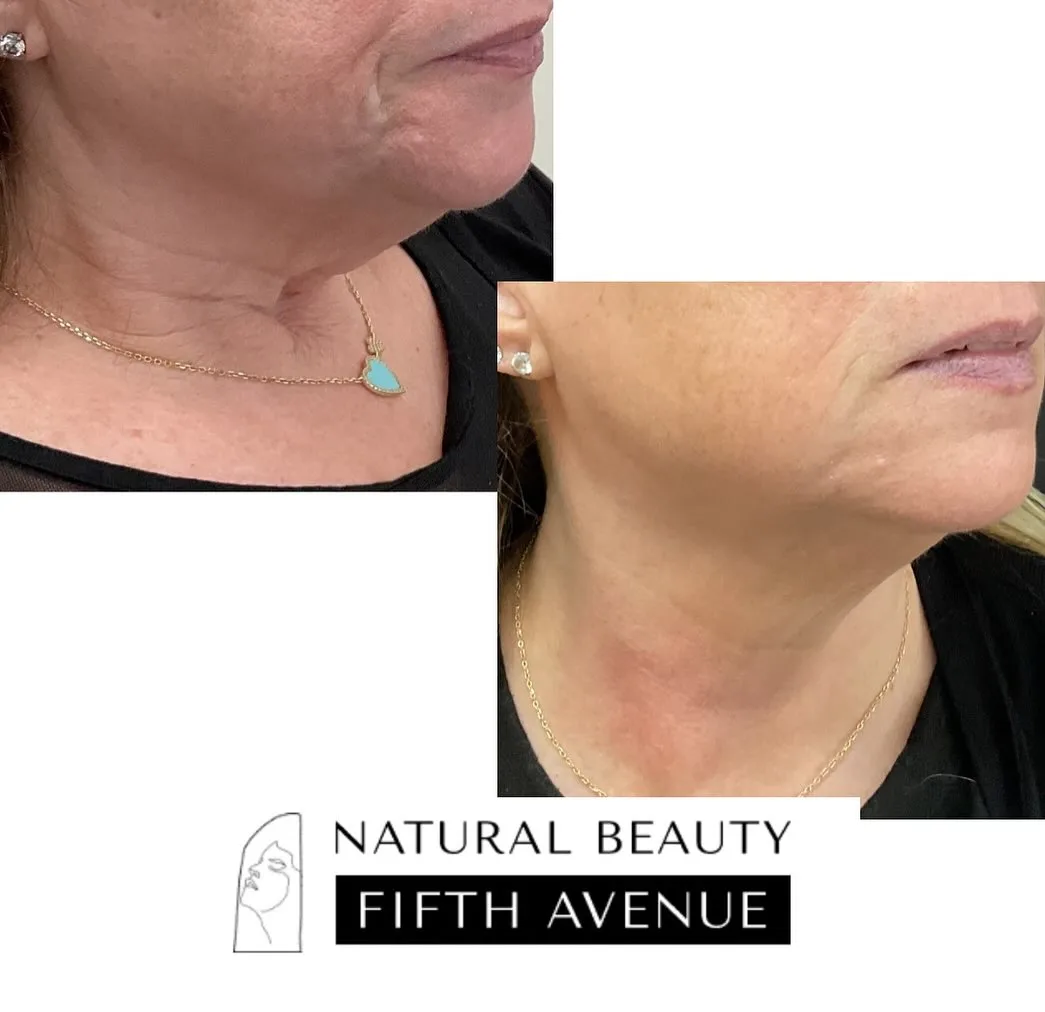 Wrinkle Relaxer before and after at Natural Beauty NYC (2 of 2)