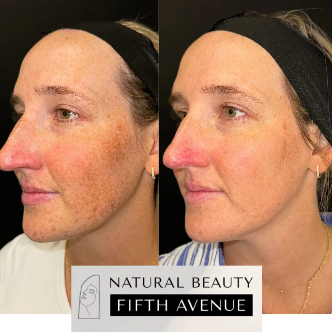 IPL Case 1 before and after