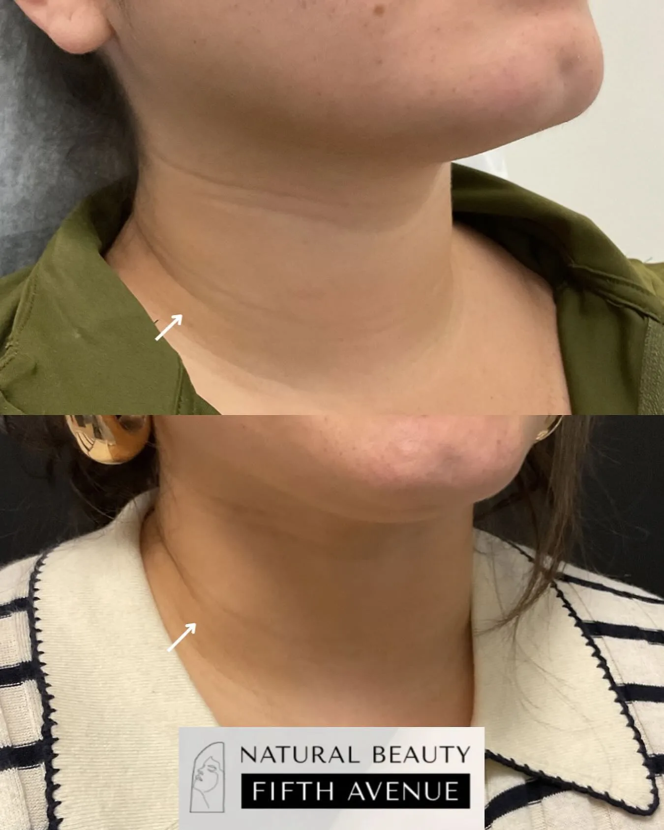 Filler and RF Microneedling before and after at Natural Beauty NYC (3 of 3)