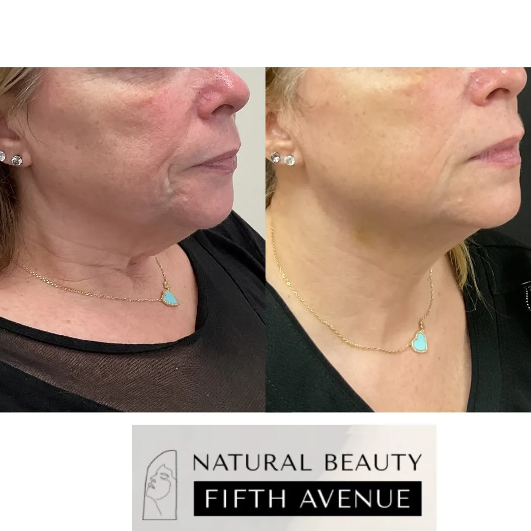 Nefertiti Lift Case 2 before and after at Natural Beauty NYC (2 of 4)