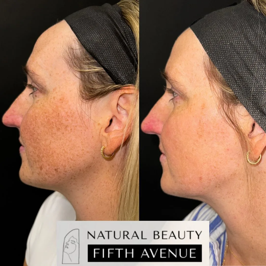IPL Case 1 before and after at Natural Beauty NYC (3 of 5)