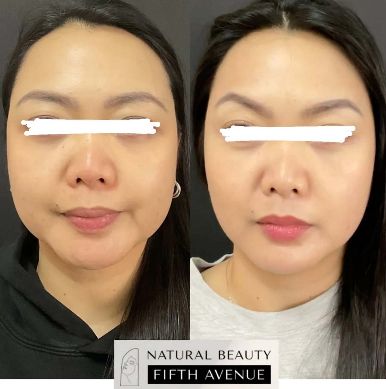 Wrinkle Relaxer & Filler before and after at Natural Beauty NYC (2 of 5)