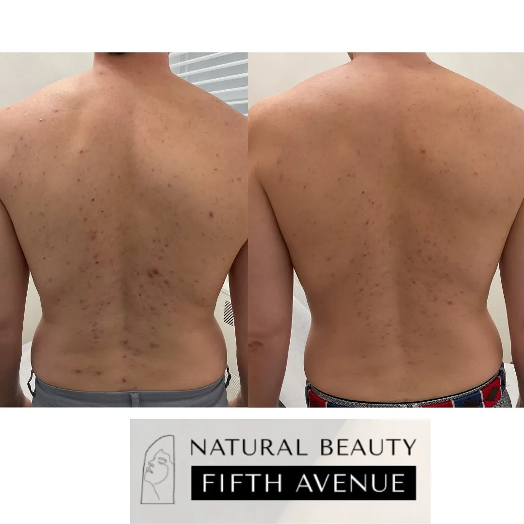 IPL, Chemical Peel Case 3 before and after
