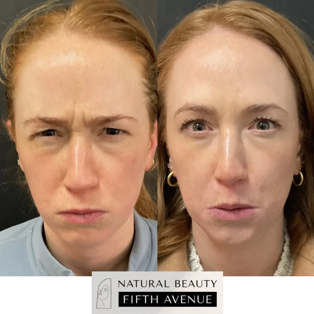 Brow Lift Case 1 before and after at Natural Beauty NYC (3 of 3)