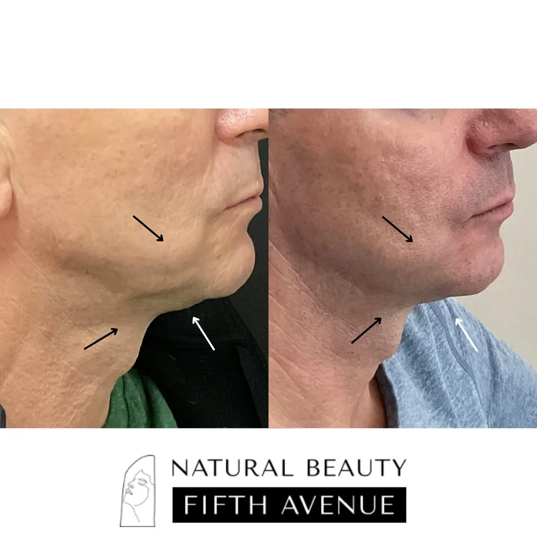 IPL. Botox, RF Microneedling, Radiesse,  and Frax before and after