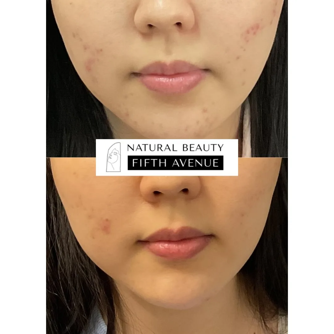Chemical Peel Case 2 before and after at Natural Beauty NYC (2 of 2)