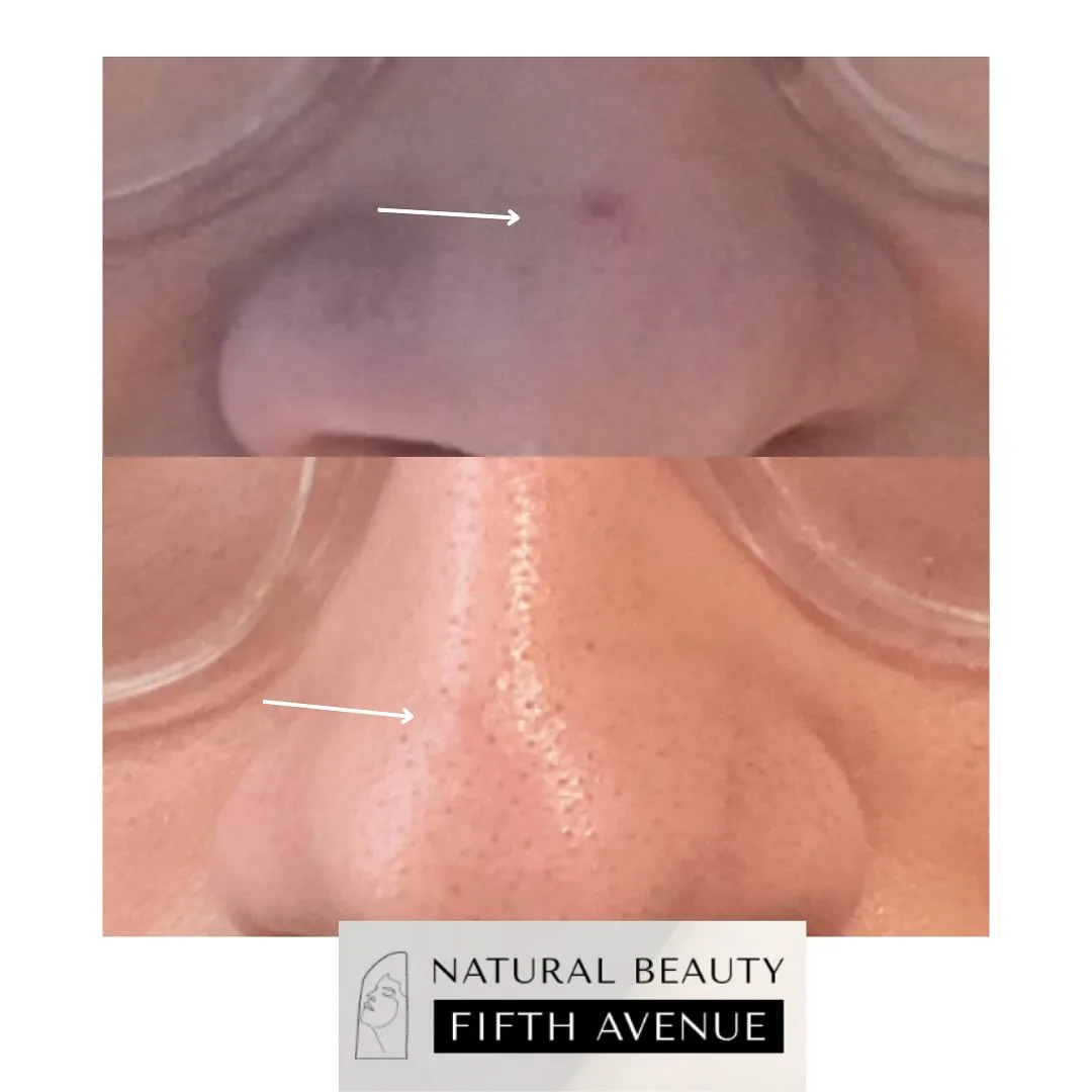 Hyfrecator and Curettage before and after