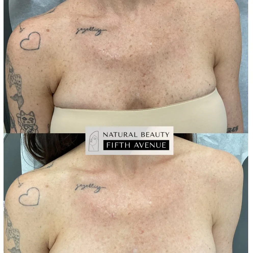 Nordlys IPL treatment before and after