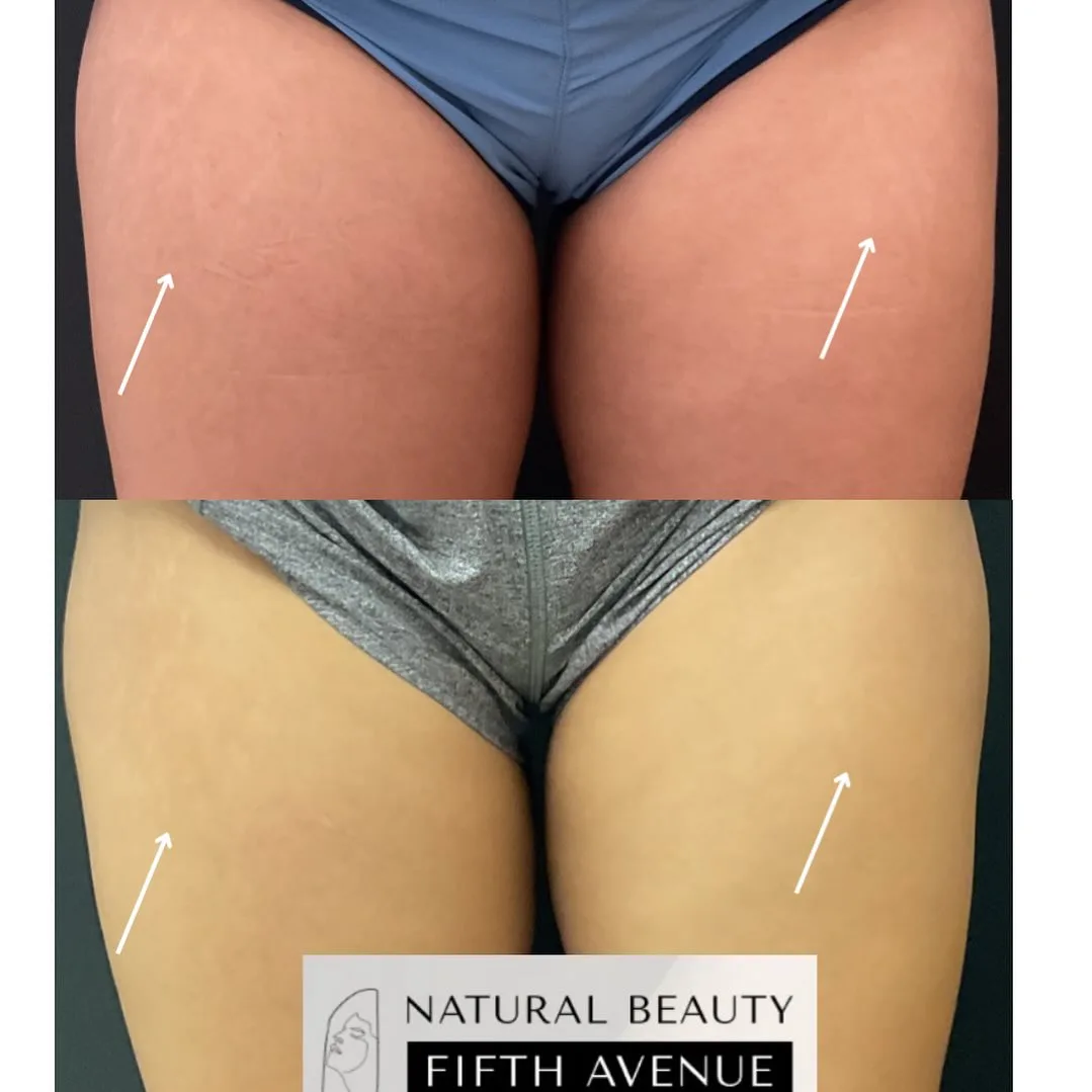 RF Microneedling with PRP Case 3 before and after at Natural Beauty NYC (2 of 2)