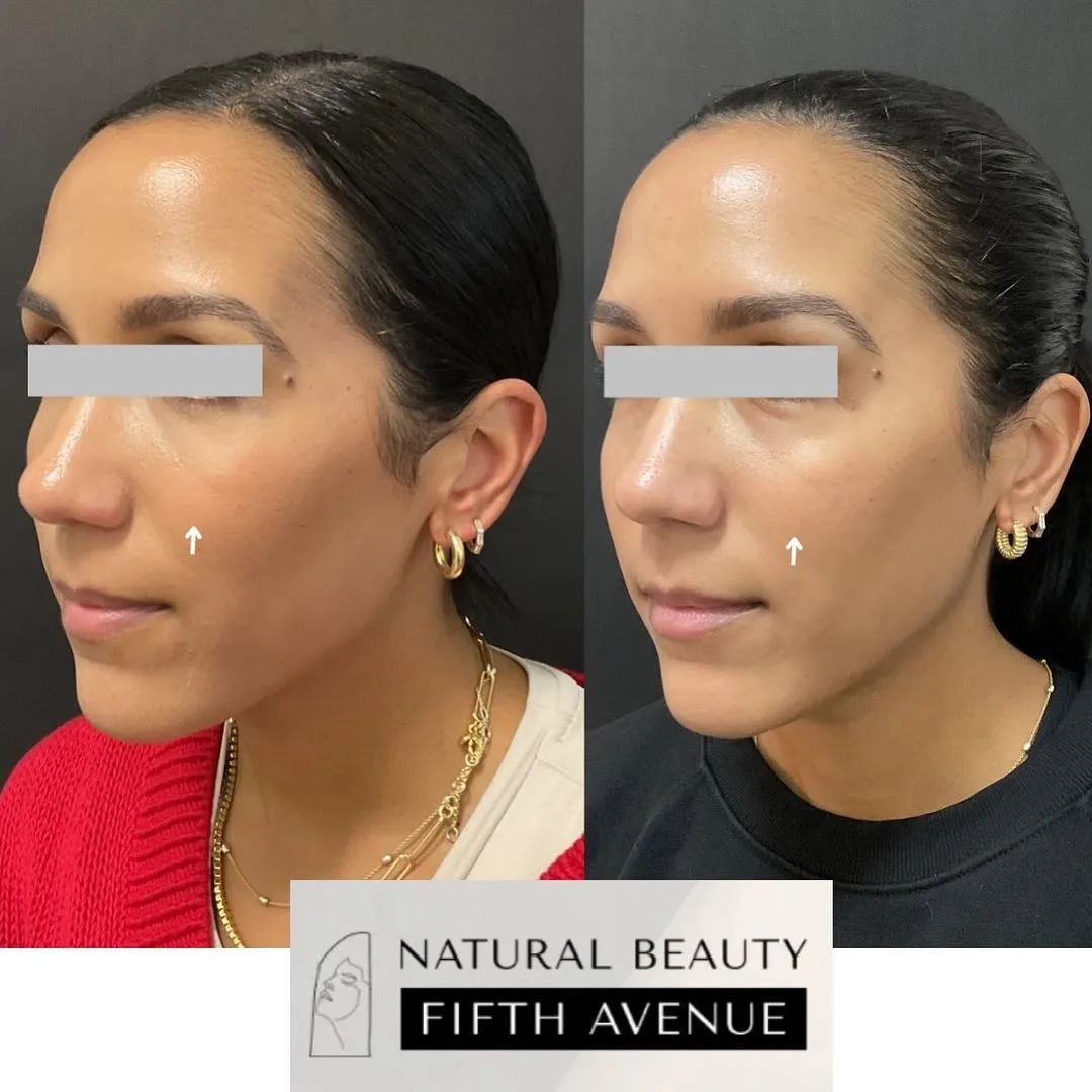 Dermal Filler Case 6 before and after at Natural Beauty NYC (4 of 4)