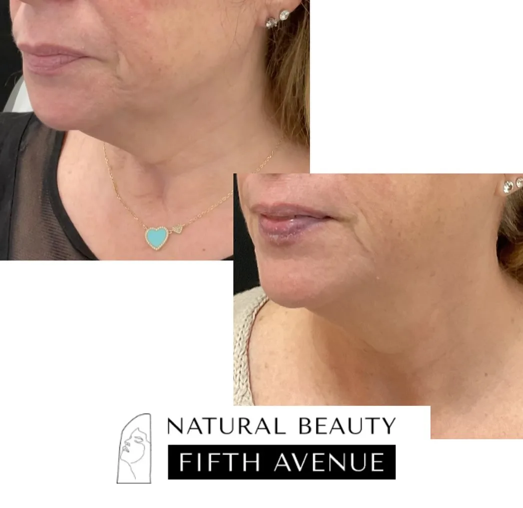 Wrinkle Relaxer before and after