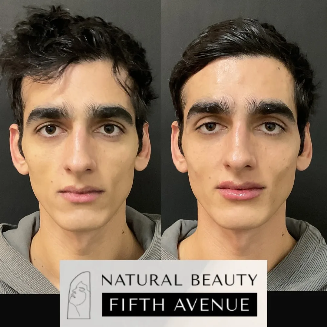 Dermal Fillers Case 8 before and after