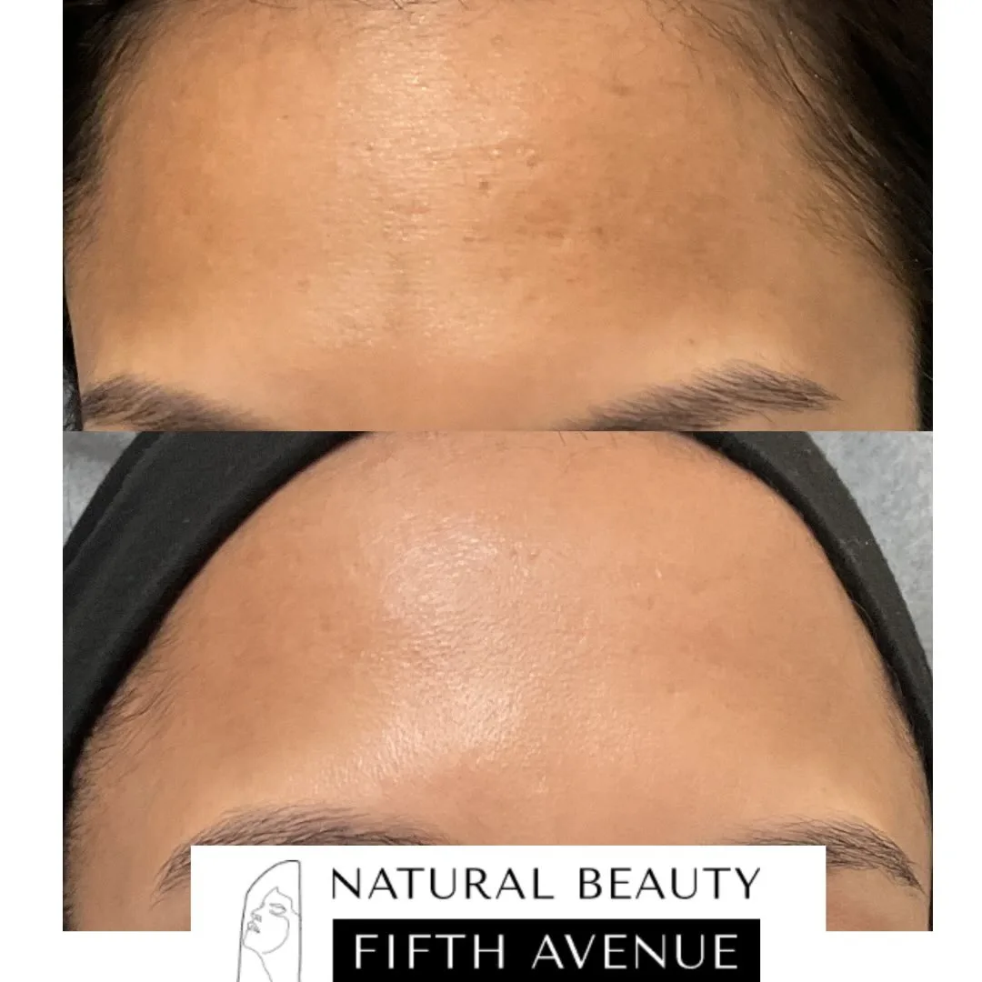 Acne Scar Treatment - Case 1 before and after