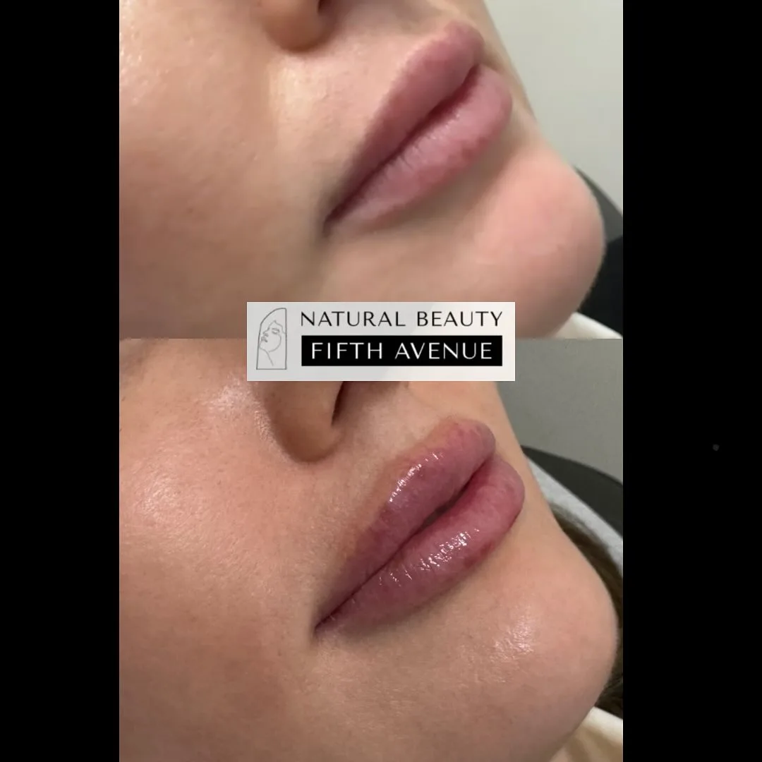 Lip Gloss Method before and after at Natural Beauty NYC