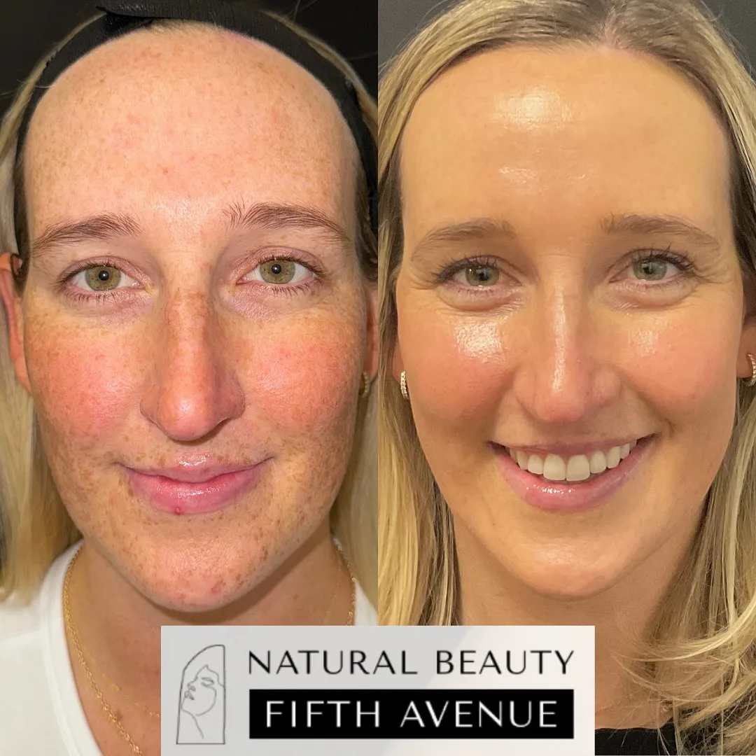 Skin Care after the procedure before and after at Natural Beauty NYC (5 of 5)
