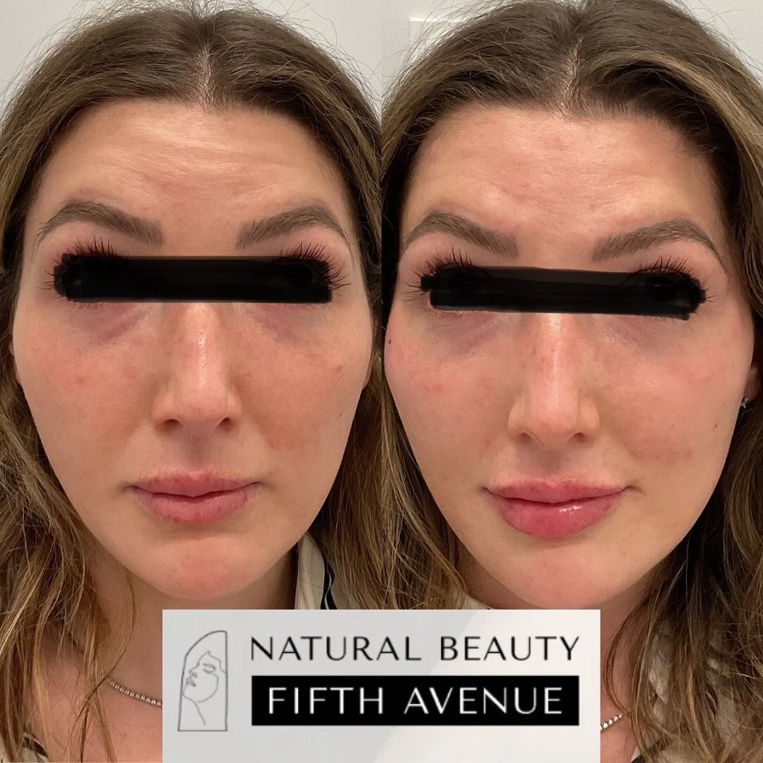 Dermal Fillers before and after