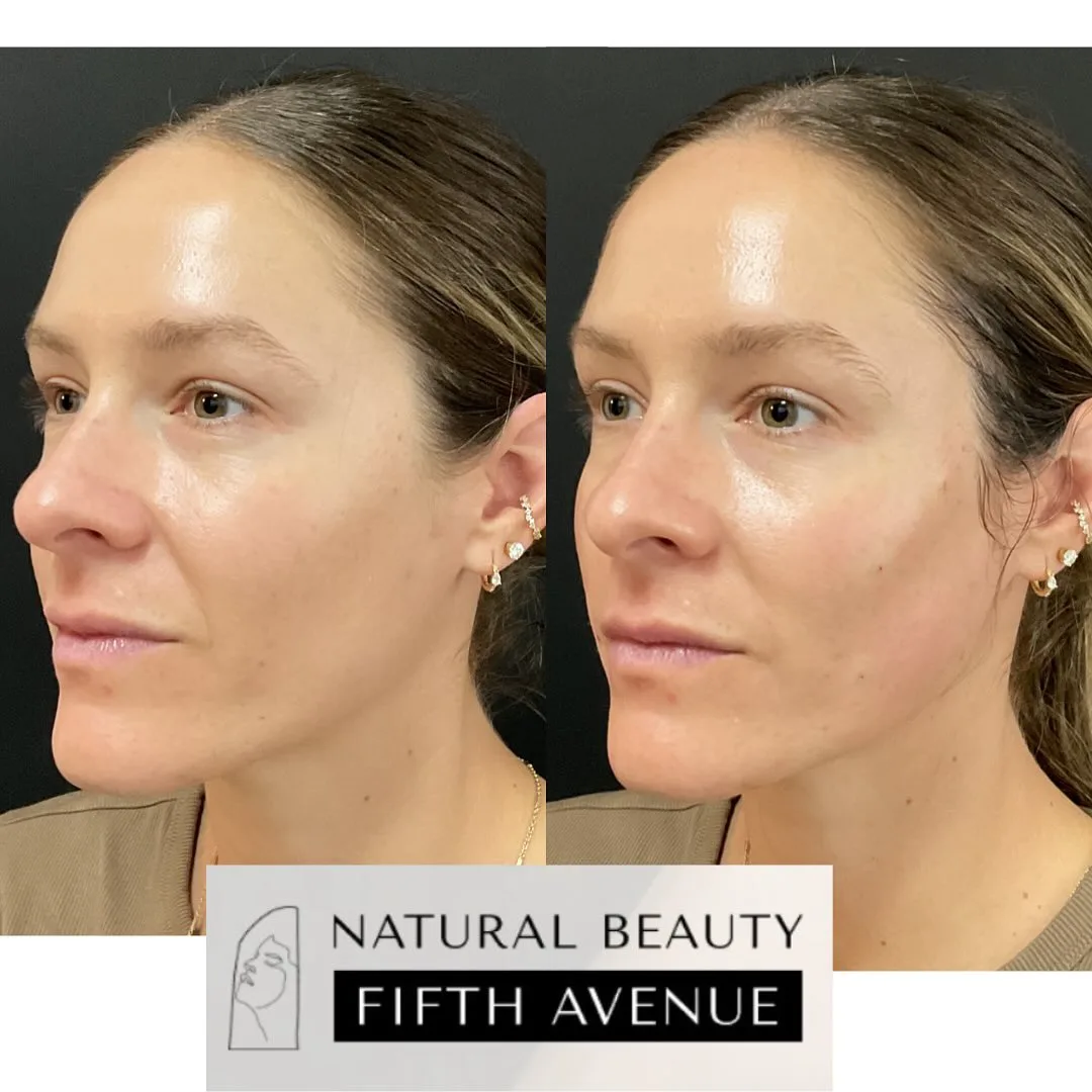 Sculptra Case 1 before and after