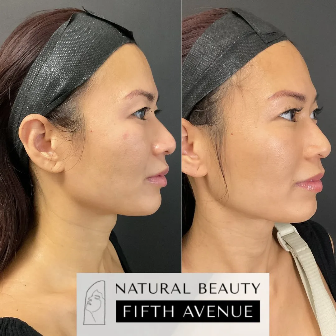RF Microneedling Case 1 before and after at Natural Beauty NYC (2 of 4)