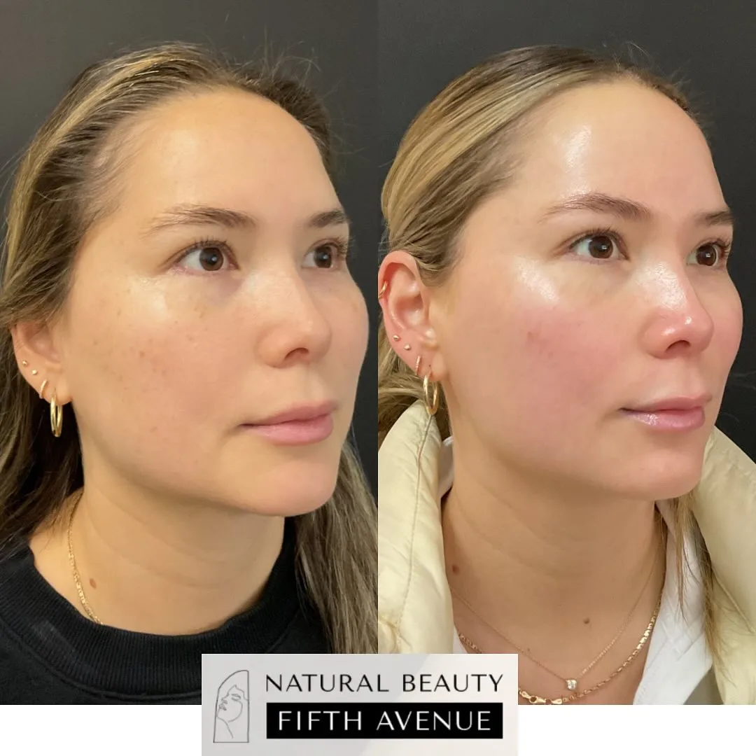 IPL , Chemical Peels before and after