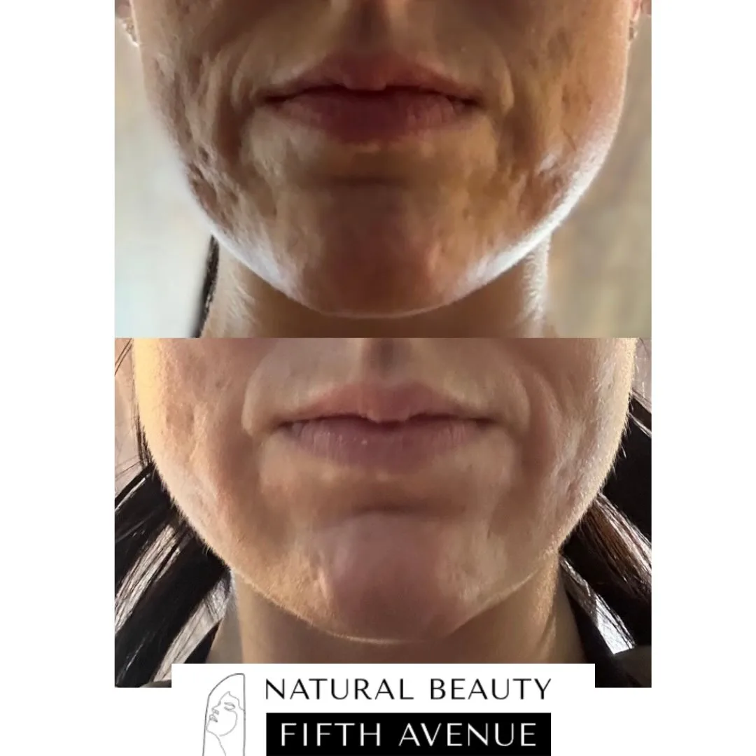 TCA CROSS and Radiesse before and after