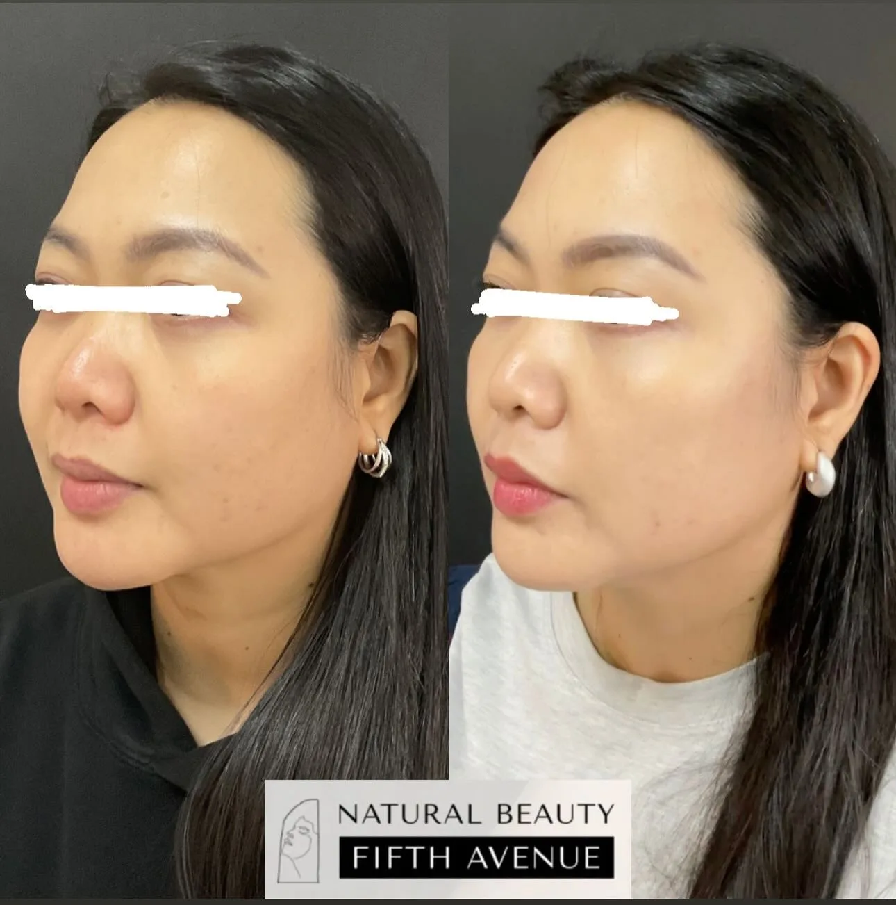 Wrinkle Relaxer & Filler before and after at Natural Beauty NYC (3 of 5)