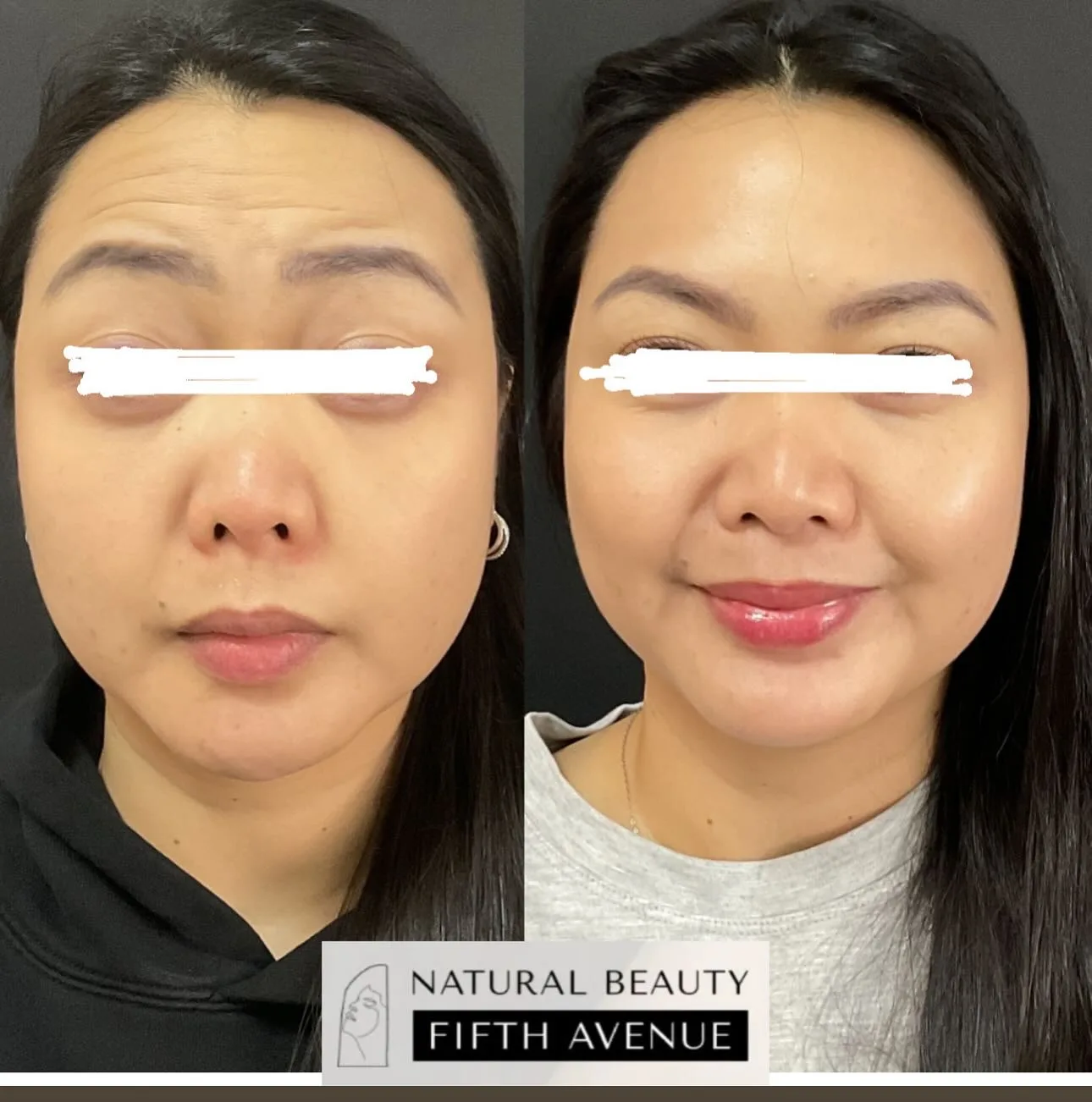 Wrinkle Relaxer & Filler before and after